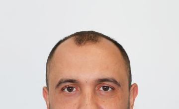 Dr Resul Yaman Hair Clinic - 4410 Grafts Result