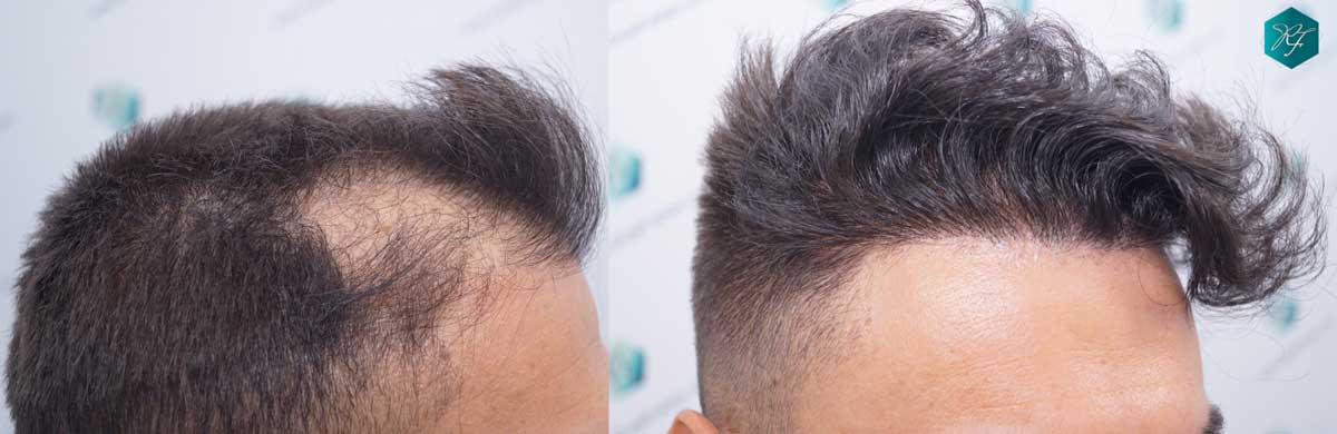 Repair to old Hair transplant