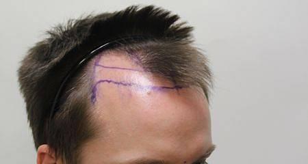 FUE Hair Transplant Procedure