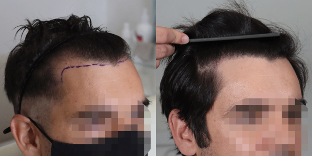 Frontal view - before and after