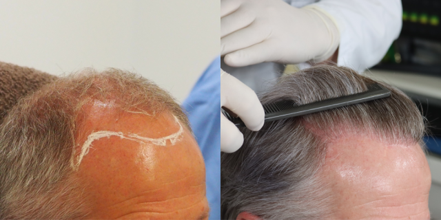 Right side before and after hair transplant