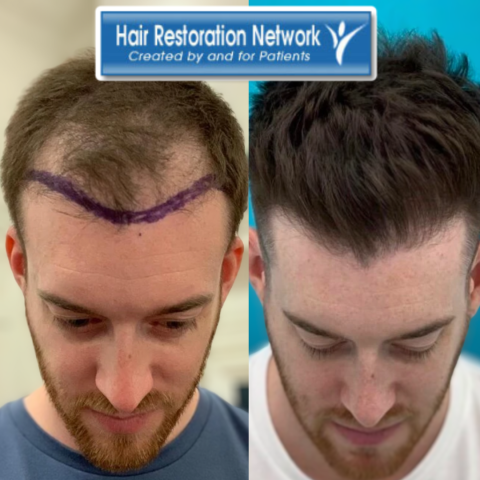 Why You Should Join The Hair Restoration Network