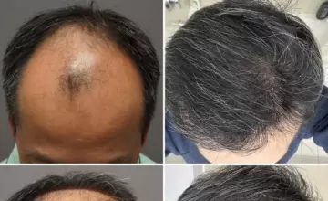 Dr. Ratchathorn Panchaprateep (Absolute Hair Clinic) 4227 Grafts 2024-06-11 Thailand. Six month Update.
