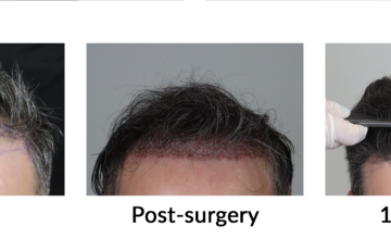 Dr. Espinosa Custodio (Spain and Mexico) - 2,571 grafts - FUE/DHI Hair Transplant