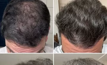 Hattingen Hair - FUE transplant 3854 grafts - March 14, 2025