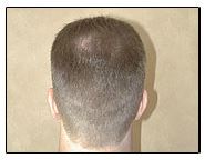 Donor scar 14 months after hair transplant