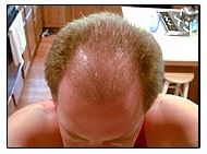 4 months after hair transplant surgery