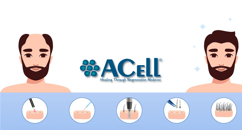 ACell for Hair Restoration And Hair Duplication