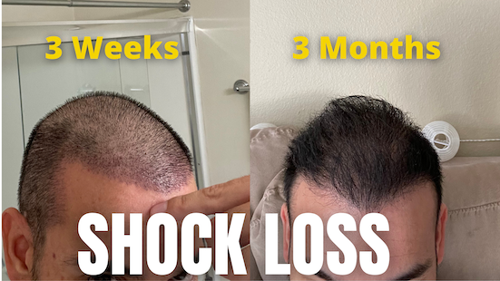 hair transplant growth phases