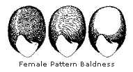 Female Pattern Baldness Hair Transplant Network