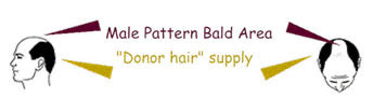 male pattern baldness