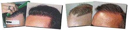 Female Pattern Baldness