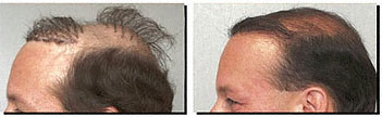 Female Pattern Baldness