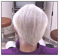 scalp reduction