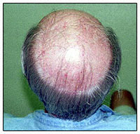 scalp surgery