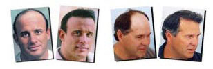 hair-transplant-before-after