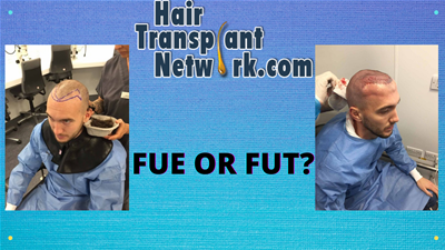 which hair transplant method is best