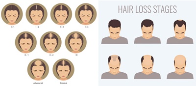 men and female hair loss stages