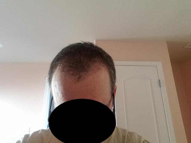 Two months post-op hairline