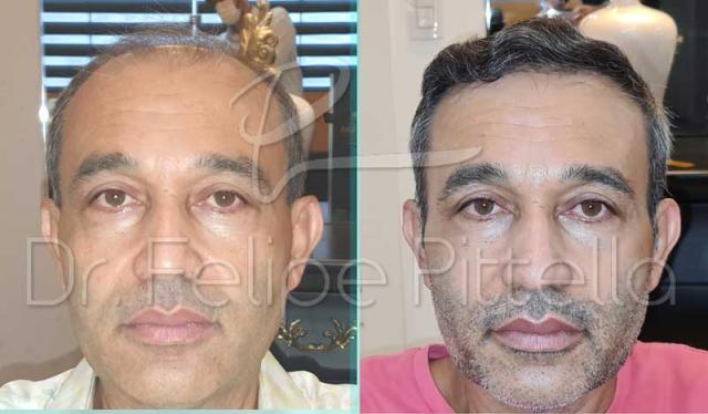 Frontal area before and after hair transplant surgery