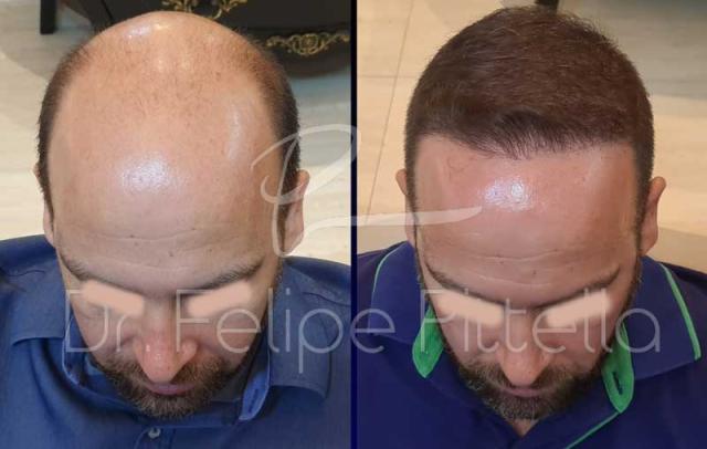 Top view of patient, before and after FUE surgery