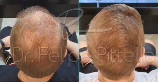 Back of patient - before and after 8122 FUE hair transplant surgery
