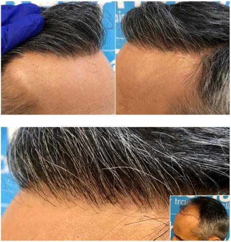 Close up of hair line