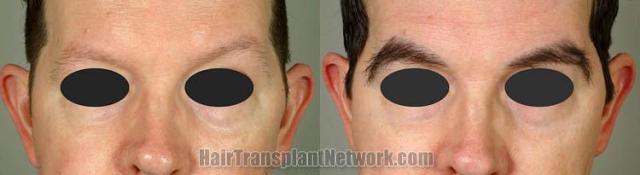 Front view - Before and after eyebrow transplant surgery