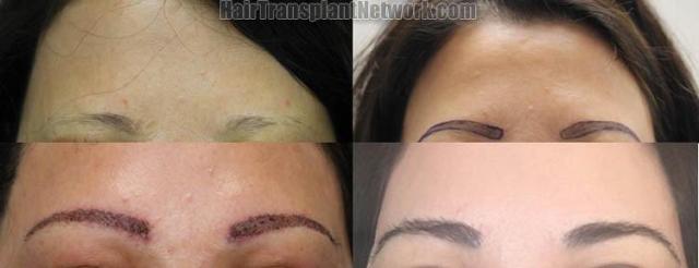 Eyebrow restoration procedure before and after results