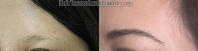 Eyebrow restoration surgery before and after photos