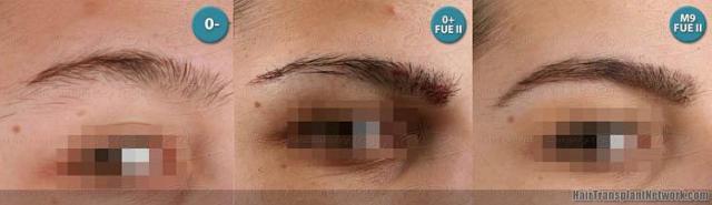 Eyebrow restoration procedure before and after pictures