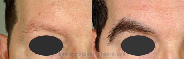 Left view - Eyebrow transplant surgery before and after photos