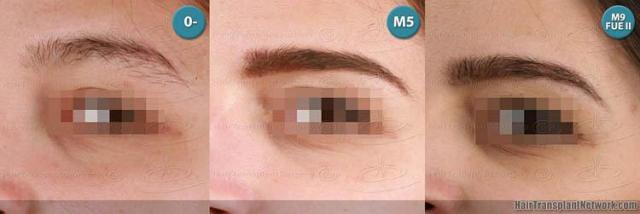 Eyebrow transplantation surgery before and after images