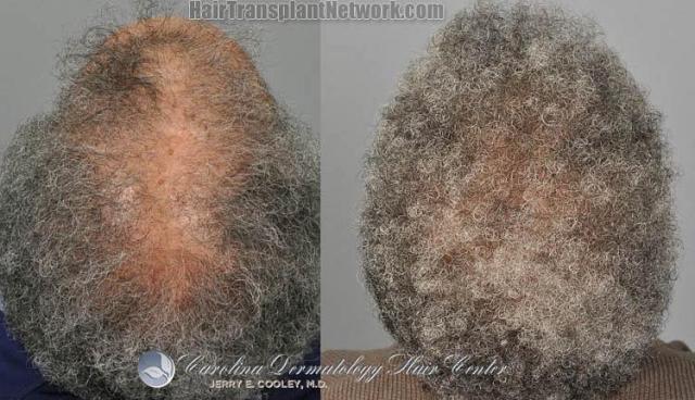 Female hair replacement surgery before and after images