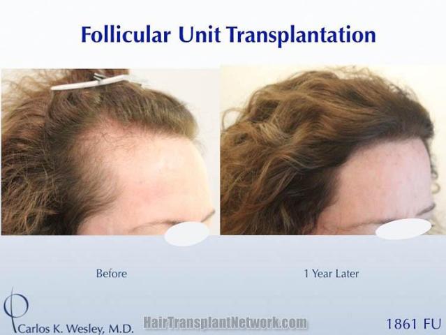 Female hair transplantation procedure before and after result