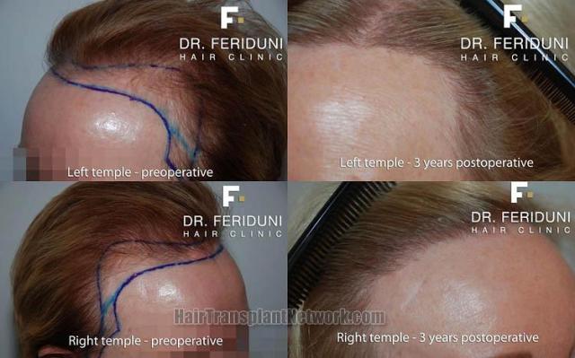 Hair restoration surgery before and after photos