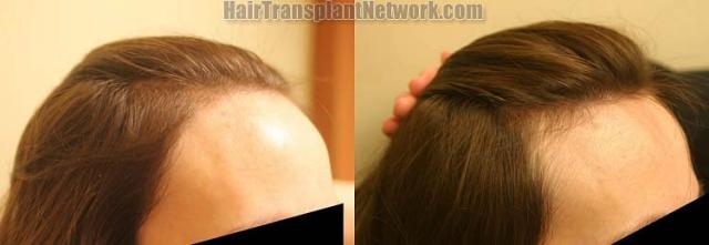 Female hair transplantation surgery before and after photos