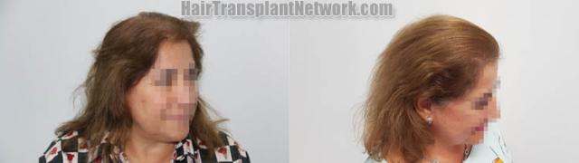 Female  before and after photos