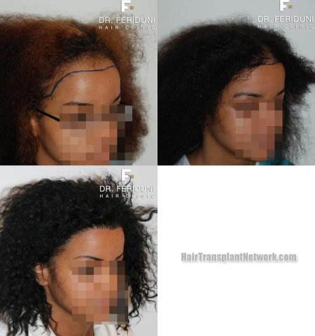 Hair restoration surgery before and after photos