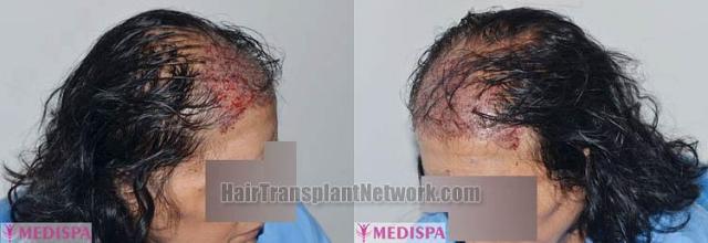 Female hair transplantation immediate postoperative photos
