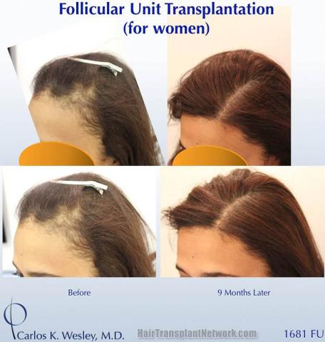 Female hair restoration surgical procedure before and after pictures