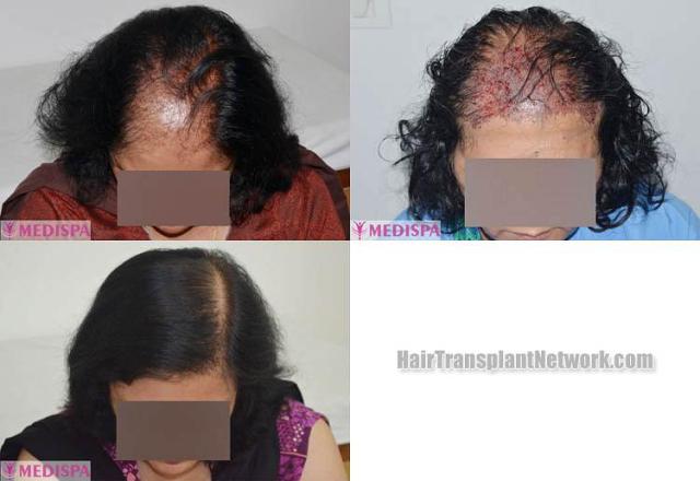 Female hair restoration procedure before and after result photos