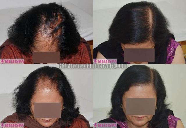 Female hair transplantation procedure before and after photos