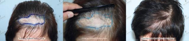 Female hair replacement surgery before and after images