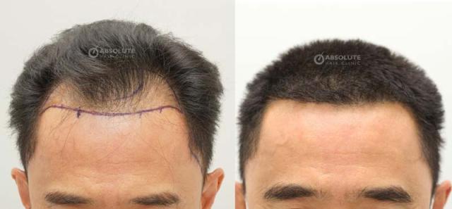Frontal area before and after surgery 