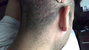 How To Deal With FUE Pain Post-Op