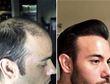 Why I Decided To Have A Hair Transplant