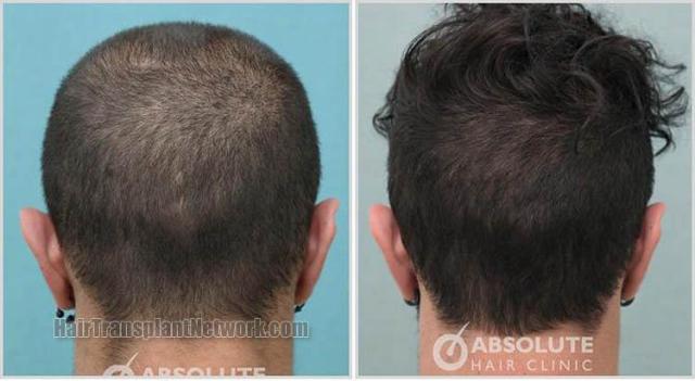 Hair transplantation procedure before and after photo results
