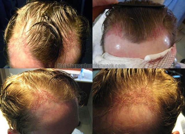 Hair restoration procedure postoperative  after photos