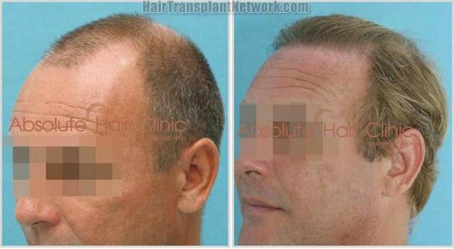 Hair transplantation surgery procedure before and after photos